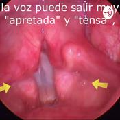 Podcast Disfonía Espasmódica