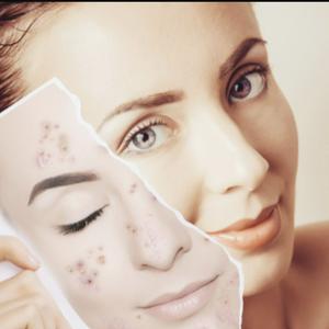 Peelings y sus beneficios